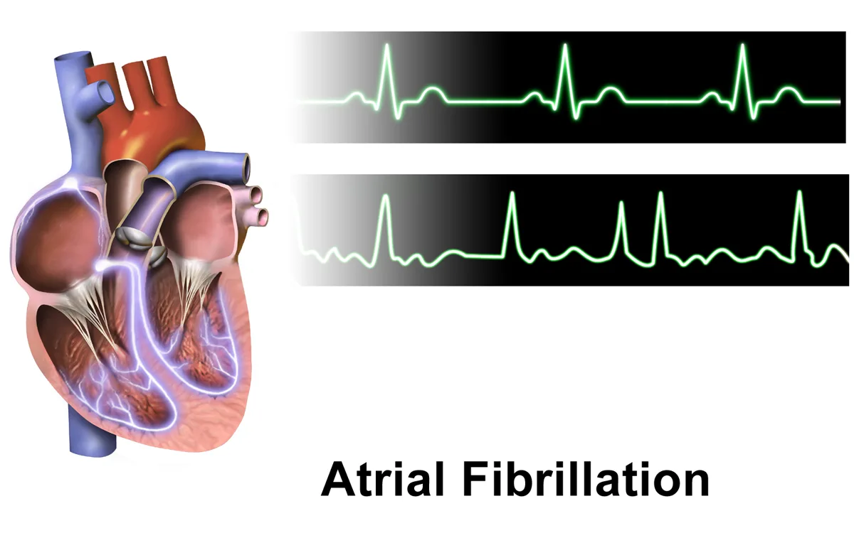 Older adult walking for light physical activity AFib stroke prevention